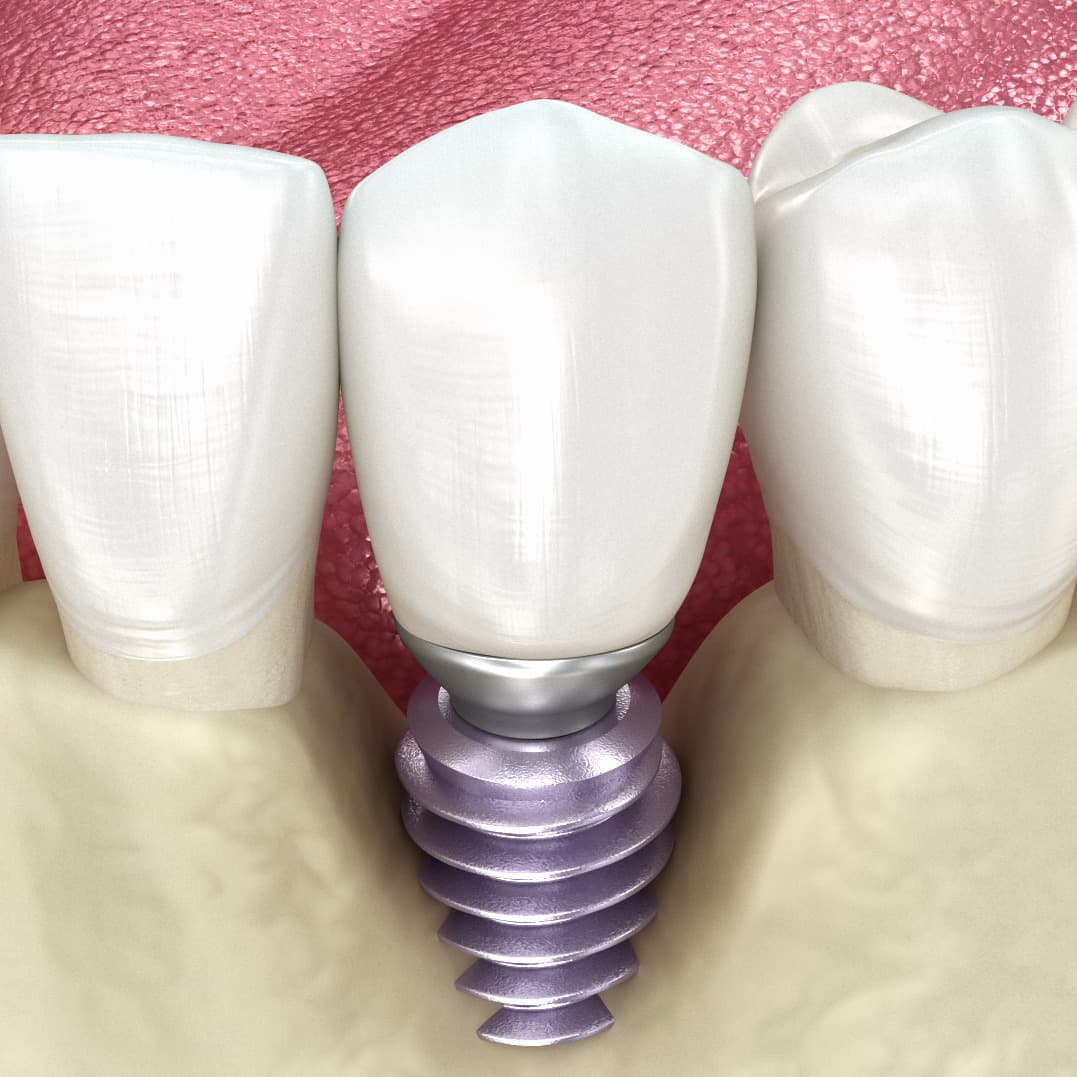 3D-Darstellung einer Implantatkrone, deren Schraube im Kieferknochen verankert ist