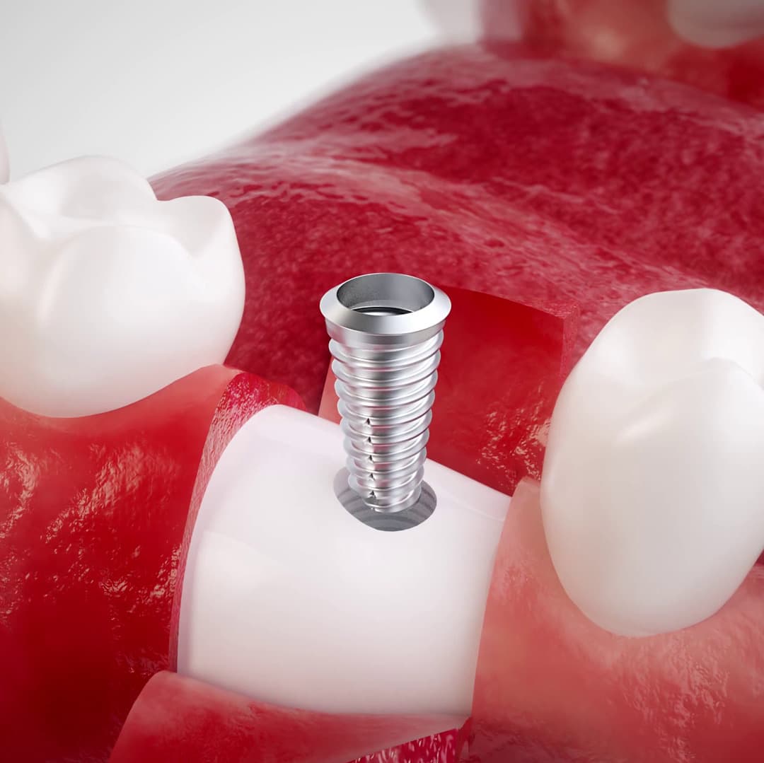 3D-Querschnitt durch den Kieferknochen mit einer eingesetzten Implantatschraube